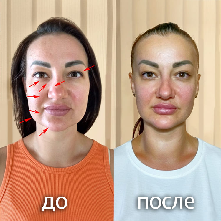 Массаж лица с лифтинг-эффектом