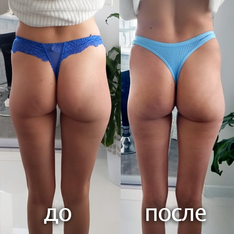 Отзыв о результате антицеллюлитного массажа